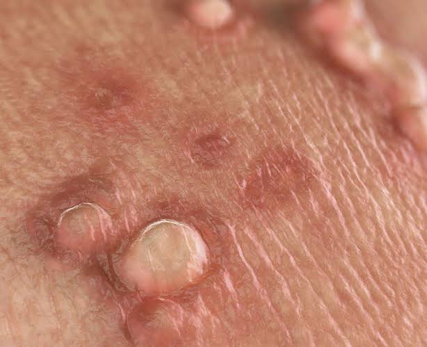 hpv-o-nam-gioi-dau-hieu-nguy-co-va-cach-phong-ngua