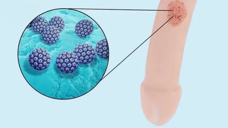 hpv-o-nam-gioi-dau-hieu-nguy-co-va-cach-phong-ngua