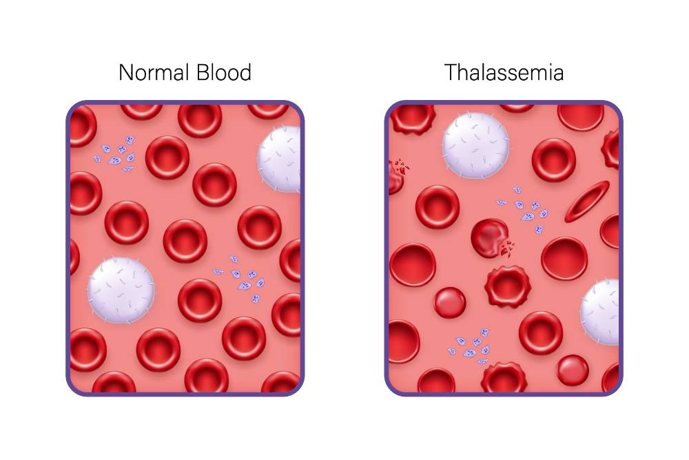 thalassemia-la-gi-tim-hieu-nguy-co-tan-mau-bam-sinh-o-tre