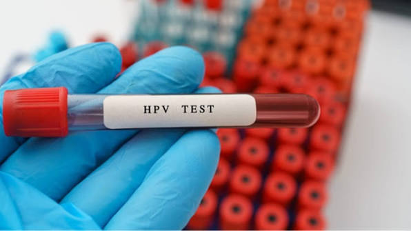 xet-nghiem-hpv-va-nhung-dieu-can-biet
