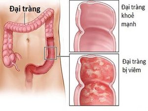 Viem-loet-dai-trang-02