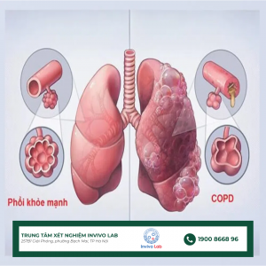 copd-la-gi