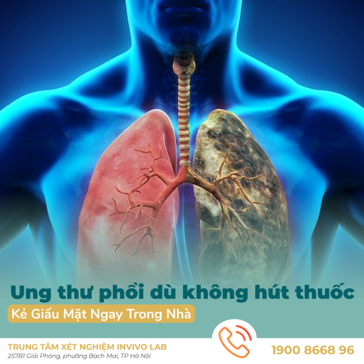 ung-thu-phoi-khong-do-thuoc-la-nhung-nguy-co-quanh-ban