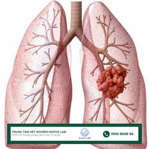 moi-lien-he-giua-copd-va-ung-thu-phoi