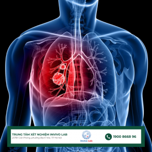 ung-thu-phoi-nguy-hiem-nhu-nao