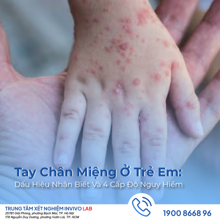 tay-chan-mieng-o-tre-em-trieu-chung-va-4-cap-do-nguy-hiem